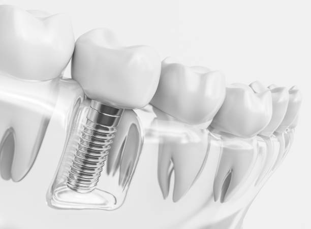 Implant